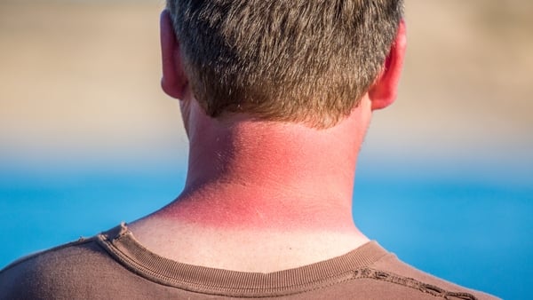 There might be a few singed arms and peeling backs around this week...